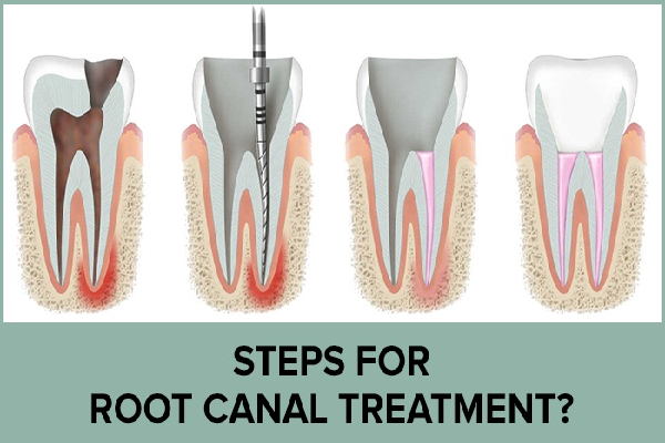 Root Canal Procedure